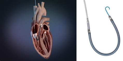 Hackensack University Medical Center Cardiac Surgeons First In World To Implant Fda Approved