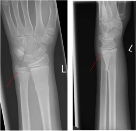 Displaced Salter Harris I Fracture Of The Distal Ulna Physis Bmj Case