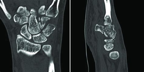 Coronal Left And Sagittal Right Computed Tomography Images Of The