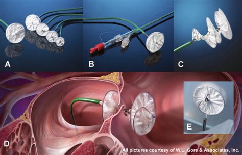 Single Centre Experience With Gore Helex Septal Occluder For Closure Of