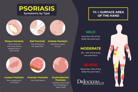 Psoriasis Causes Symptoms And Natural Support Strategies