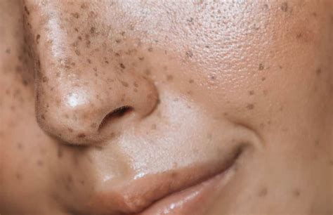 Dark Skin Pigmentation Treatment Hyperpigmentation Cost In India