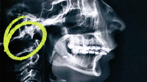 Chiari Malformation Types Treatments Life Expectancy And More