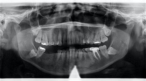 Diagnosis And Treatment For Breakthrough Clinical Oral Pathology Case