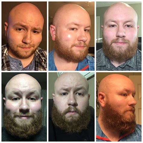 3 Months Patchy Beard Growth 🧔can I Grow A Full Beard Beardadvice
