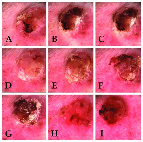 Dermoscopic Picture Of Basal Cell Carcinoma Of The Infraorbital Region