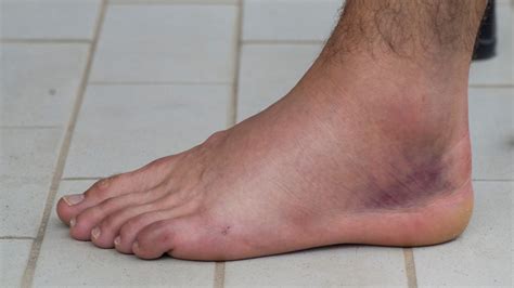 How Long Does A Sprained Ankle Stay Swollen Grades And Tips