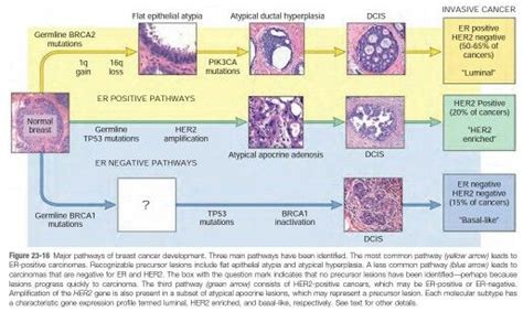 Ca Breast Pathogenesis Medical Illustrations Atypical Pathology