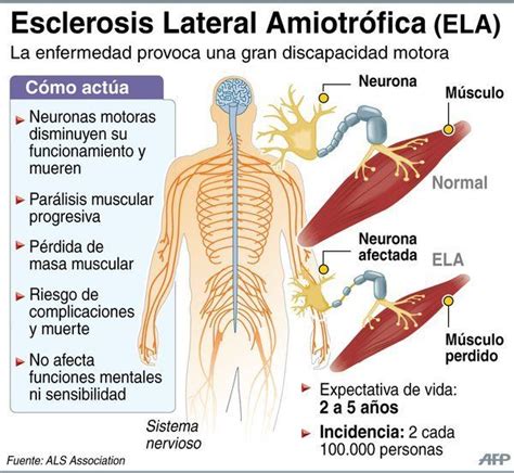 esclerosis lateral amiotrófica ela