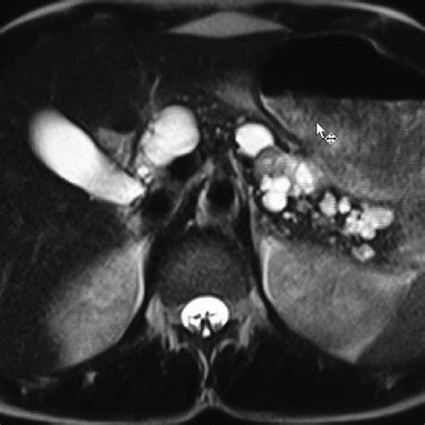 Axial Heavily T2 Weighted Mr Imaging Of Abdomen Showing Multiple Simple