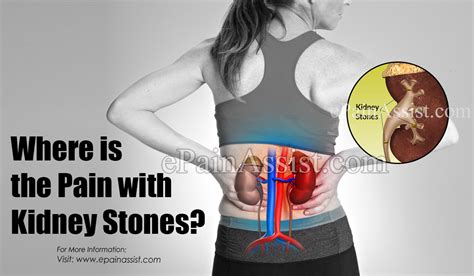 Kidney Stone Pain Diagram