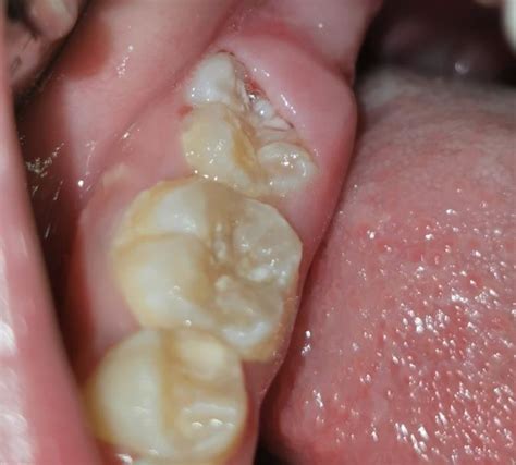 Operculum Of Lower Right Second Permanent Molar One Week After