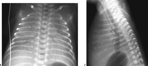 Hyaline Membrane Disease Radiology Key