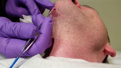 Infected Ingrown Hair Cysts Symptoms Pictures Causes On Thighs Neck