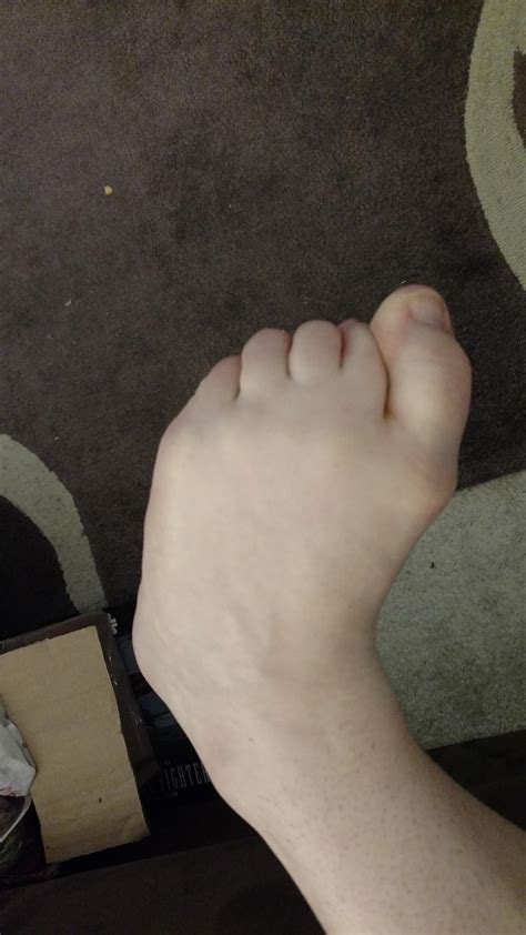 My Foot Permanently Looks Like A Fist After Having A Stroke R Mildlyinteresting