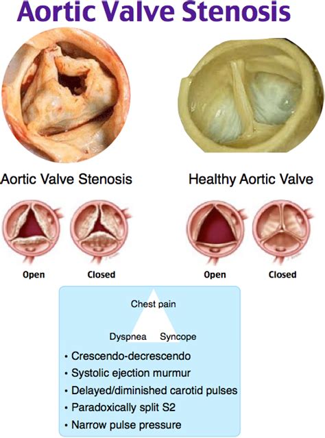 Aortic Valve Stenosis Cardiac Nursing Medical School Essentials