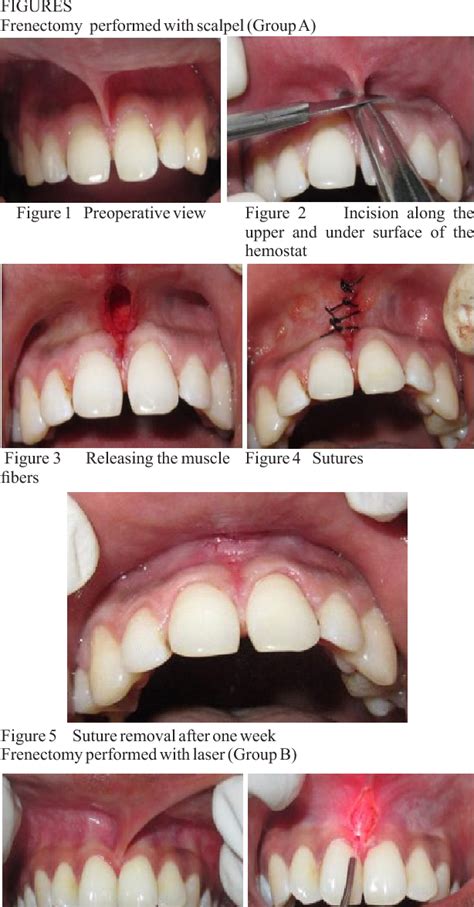 Figure 8 From Comparative Evaluation Of Frenectomy Procedures Performed