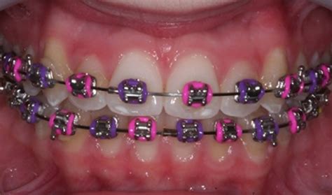 Purple Braces Look Braces Teeth Colors Braces Colors Braces Colors Combinations