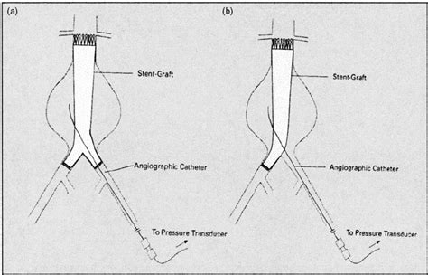 Position Of Stent Graft And Straight Angiographic Catheter During