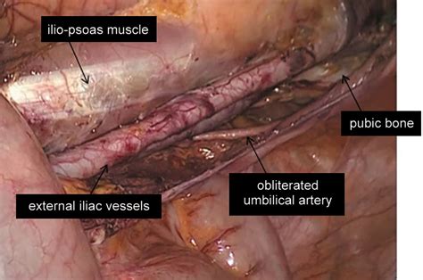 Videoscopic Inguinal Iliac Obturator Lymph Node Dissection New