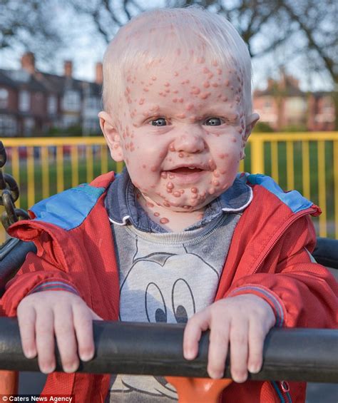 Boy With Has Rare Disease Lch Causing Chicken Pox Lumps All Over His