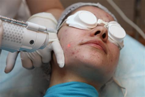 Laser Active Acne Treatment Crystal Care Clinic