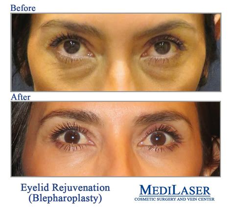 Eyelid Rejuvenation Medilaser Frisco Tx