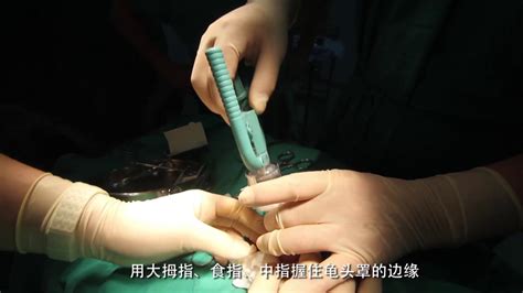 Pioneering Ryps Circumcision Anastomat For Male Circumcision Surgery Youtube