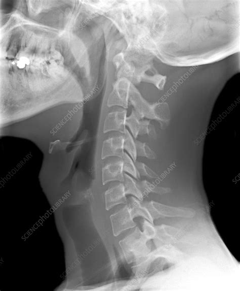 Normal Neck X Ray Stock Image C0103497 Science Photo Library