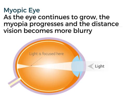 Myopia Management Coatsworth Eye Clinic