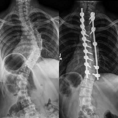 Before And After Of My Scoliosis Surgery Rscoliosis