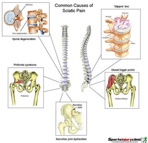 Sciatica Lumbar Radiculopathy Wake Spine And Pain