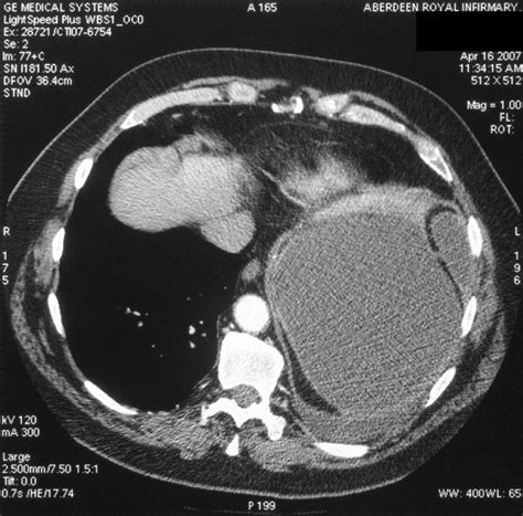 Computed Tomography Scan Axial View Of Patients Ct Scan Showing A