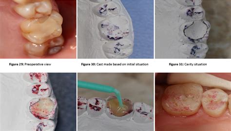 Figure 29 From Direct Posterior Composite Restorations Using Stamp