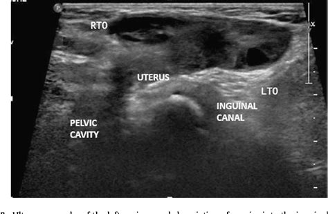 Figure From Rarity In Conspicuityultrasound Diagnosis Of Sliding