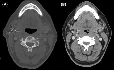 Ct Scan Of The Neck Shows An Enlarged Right Submandibular Lymph Node Download Scientific