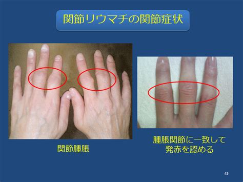関節リュウマチ指 手 指 手指に腫れ.痛み 変形 変形性指関節症 ...