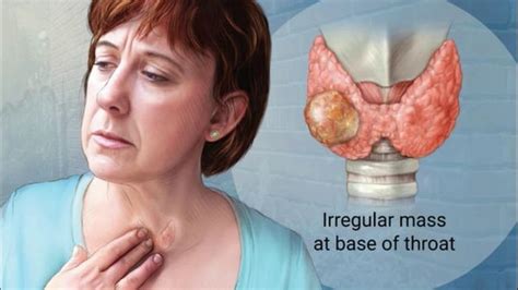 Surgery to remove all cancer in the neck and any cancerous lymph nodes is the initial therapy for most thyroid cancers. ENT Surgeries - Shreyan ENT Hospital