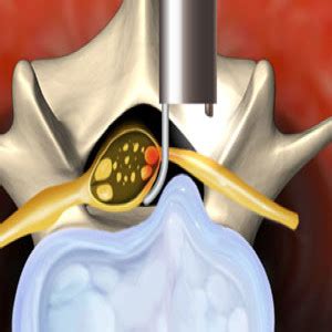 Micro Endoscopic Discectomy In Plano Frisco McKinney And Allen Plano Orthopedic Sports