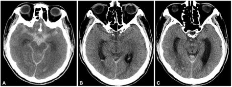 Initial Brain Ct Shows A Diffuse Acute Subarachnoid Hemorrhage
