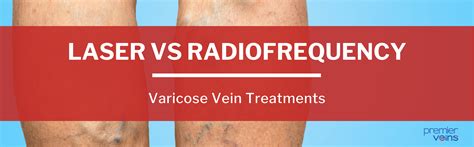 Treating Varicose Veins With Laser Vs Radiofrequency