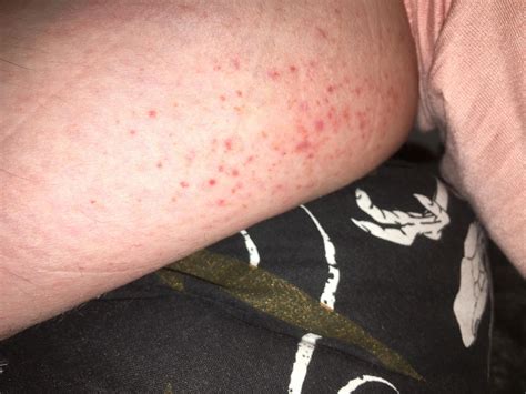 25 F Red Blotchy Rash On Lower Legs Very Itchy What Could It Be
