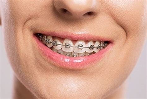 Myths About Getting Braces As An Adult Mp Orthodontics