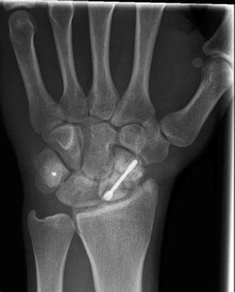 X Ray Of Scaphoid Fracture
