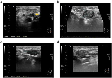 Cancerous Lymph Nodes In Neck Ultrasound