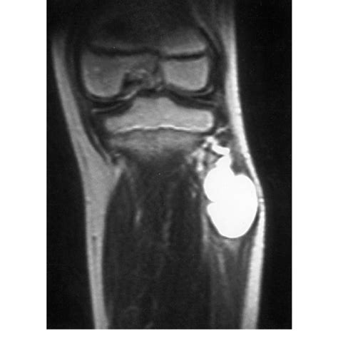 Pdf Synovial Cysts Of Proximal Tibiofibular Joint Causing Peroneal