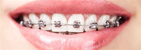 How Are Braces Put On A Step By Step Process Faqs