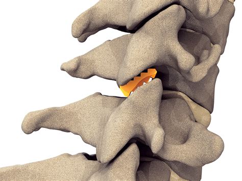 Advanced Technology For Posterior Cervical Fusion