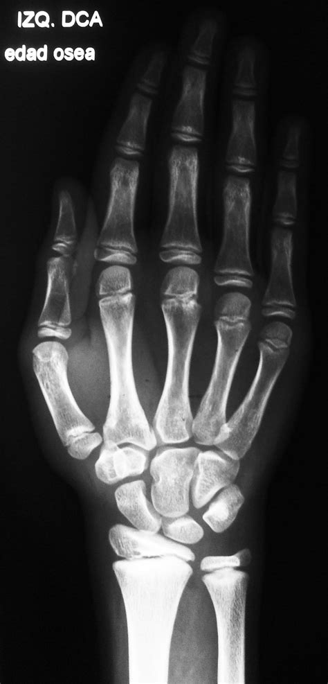 Radiografía De La Mano Frente Radiografia Y Manos