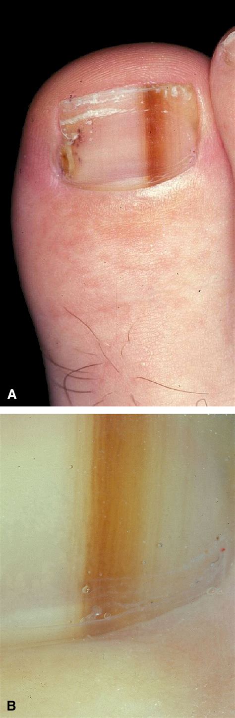 Diagnosis And Management Of Nail Pigmentations Journal Of The